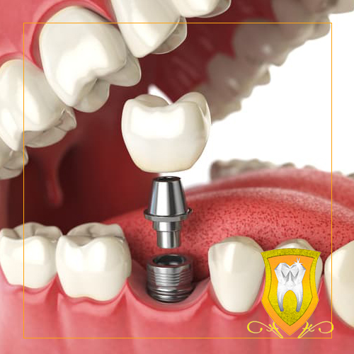 بررسی عوارض ایمپلنت دندان